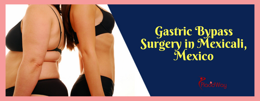 Gastric Bypass Surgery in Mexicali, Mexico